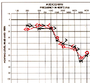 Graph of hearing test