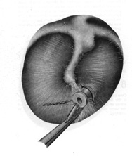 Black and white illustration of an ear tube inserted into th