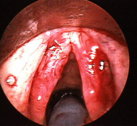 Close up of post op Reinkes edema