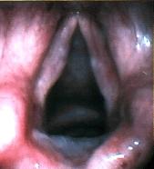 Close up of vocal folds Reinkes edema procedure later post-o