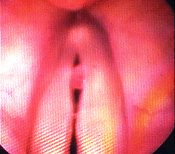 Close up of a vocal cyst