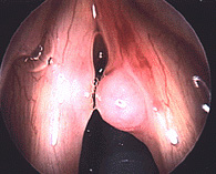 Close up of a large right vocal cyst