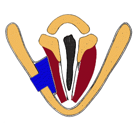 A colored illustration of a vocal fold implant